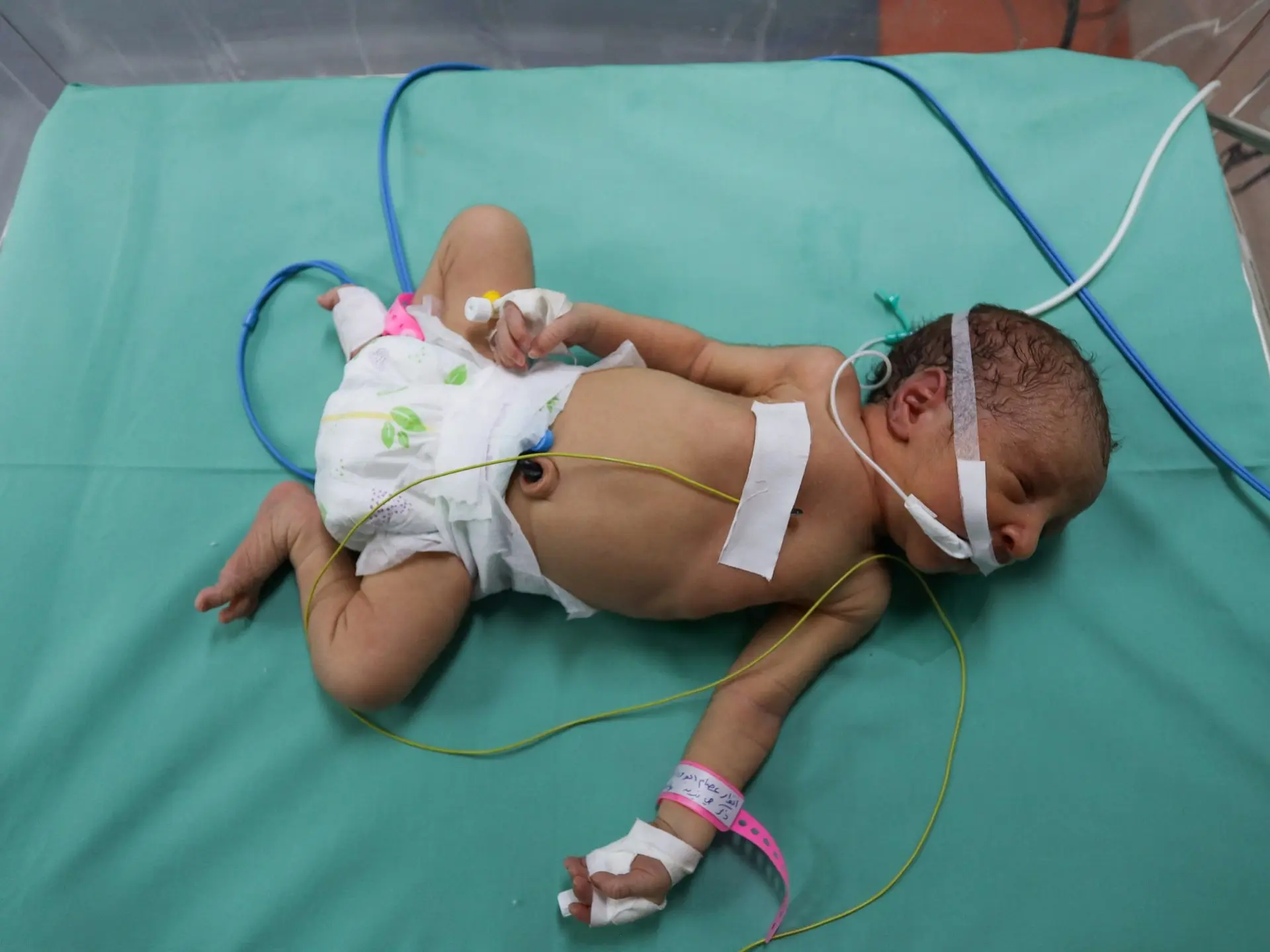 ‘Painful, Preventable Deaths’: Newborn Mortality in Gaza Soars 75% as Maternal Malnutrition Deepens ‘Painful, Preventable Deaths’: Newborn Mortality in Gaza Soars 75% as Maternal Malnutrition Deepens