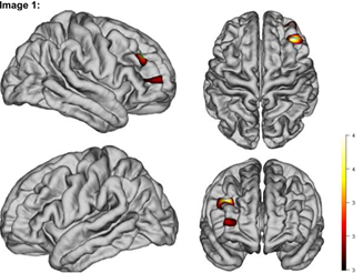 LONG-TERM HEAVY CANNABIS USE LINKED TO THINNING IN FRONTAL BRAIN REGION LONG-TERM HEAVY CANNABIS USE LINKED TO THINNING IN FRONTAL BRAIN REGION